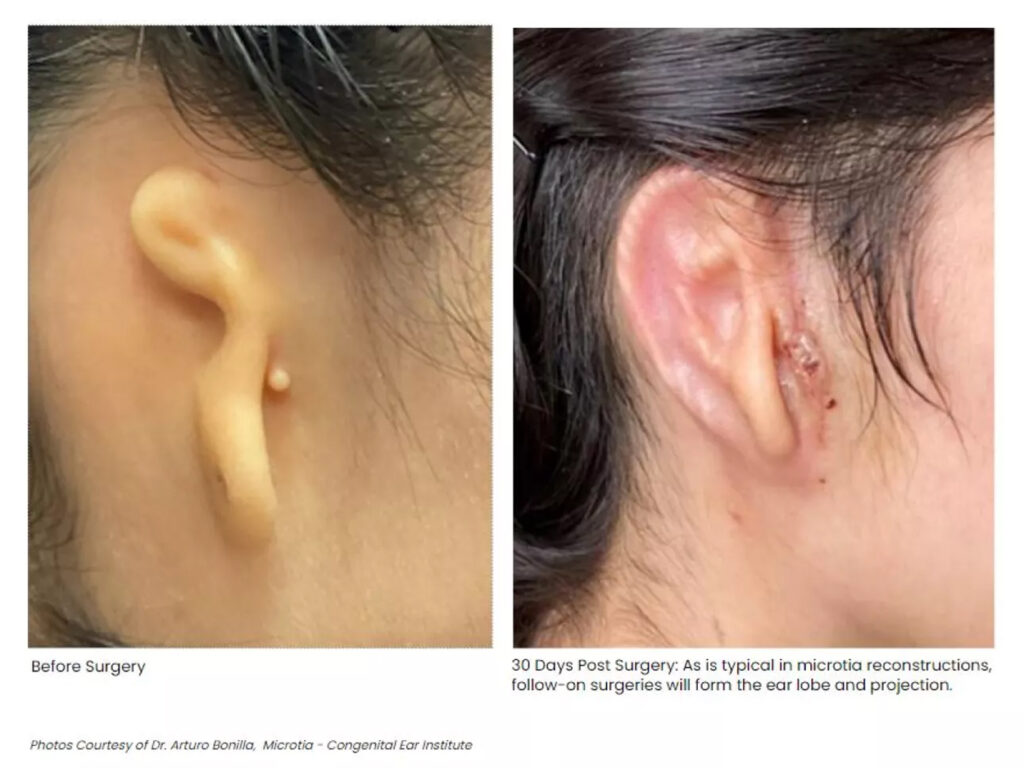 3D printed ear recipient