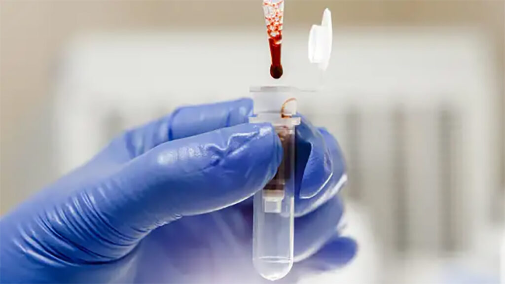 Unprecedented Two Human Patients Receive Lab-Grown Blood Cell Transfusion